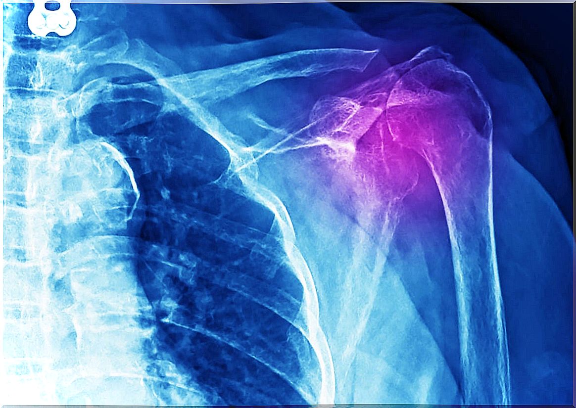 Painful shoulder x-ray.