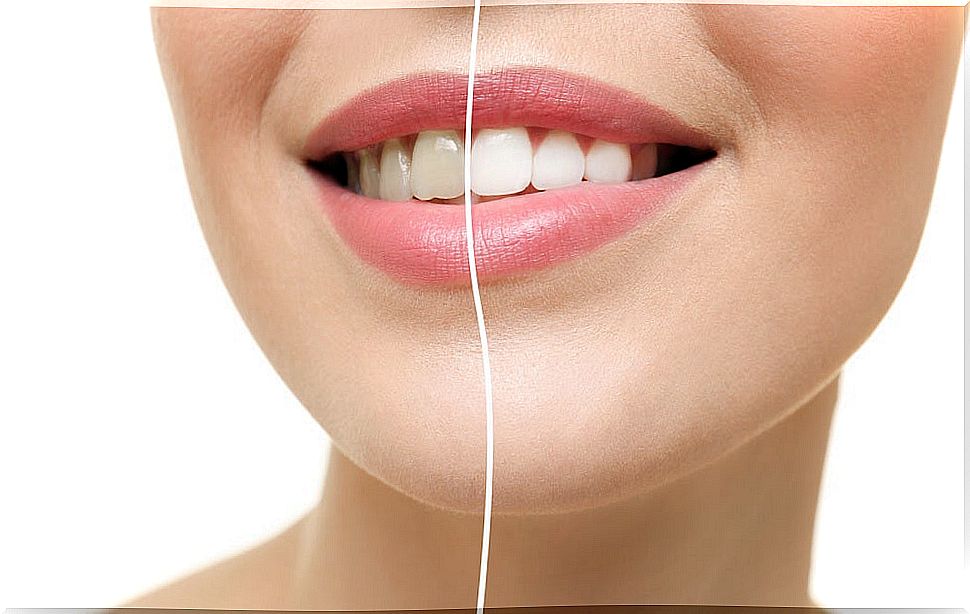 4 types of teeth whitening