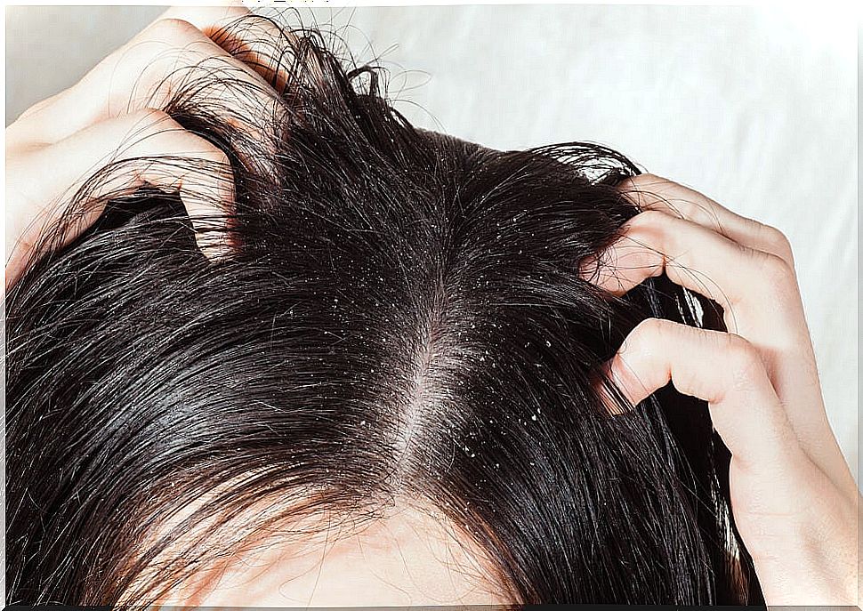 Woman scratching her head because she has dandruff.