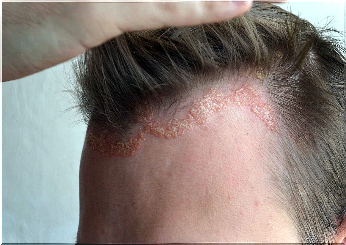 Scalp psoriasis.