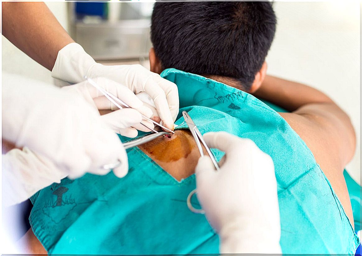 Desmoid tumor in the back being operated on.