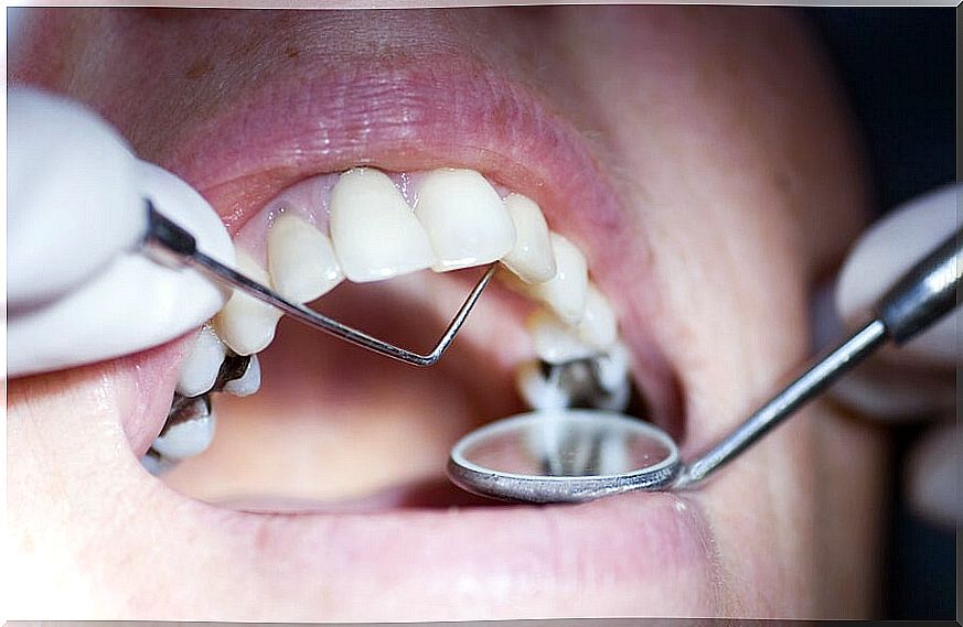 Health Risks of Amalgam Fillings