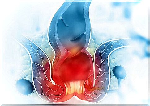 Hemorrhoids