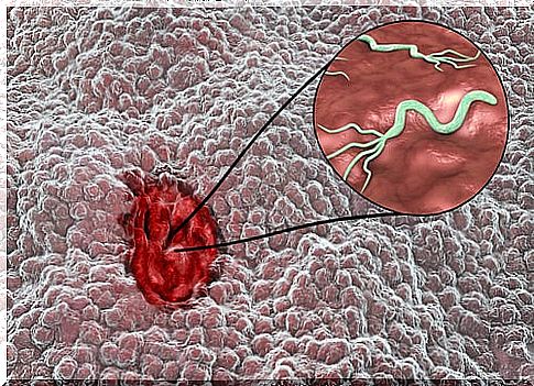 Gastric ulcer due to hellicobacter