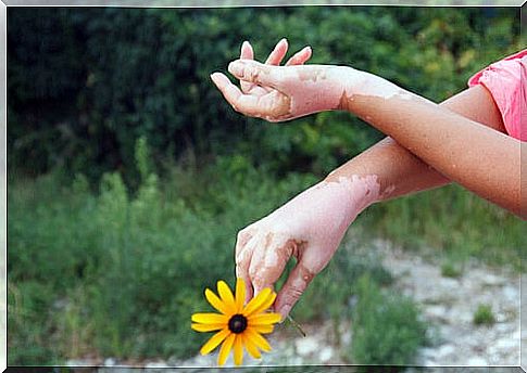 Hands with vitiligo with a flower