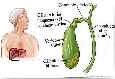 Gallstones