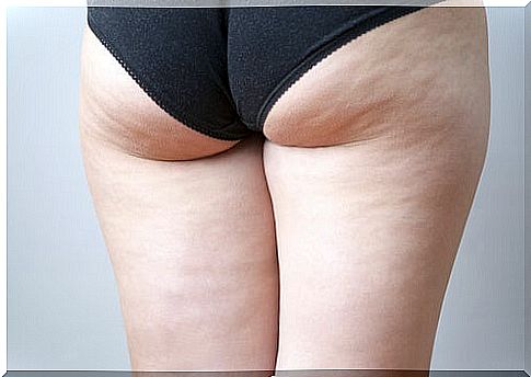 Why haven't you managed to get rid of cellulite yet?